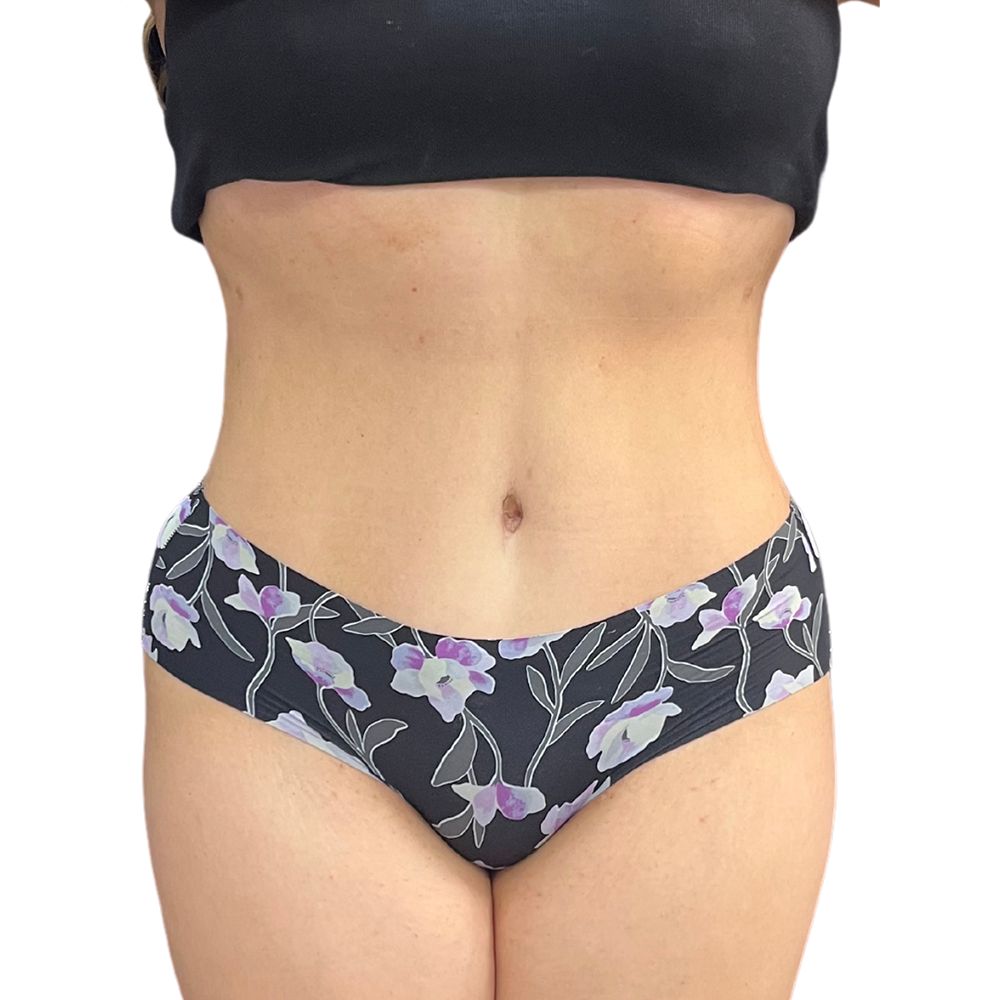 Tummy Tuck Before & After Patient #314