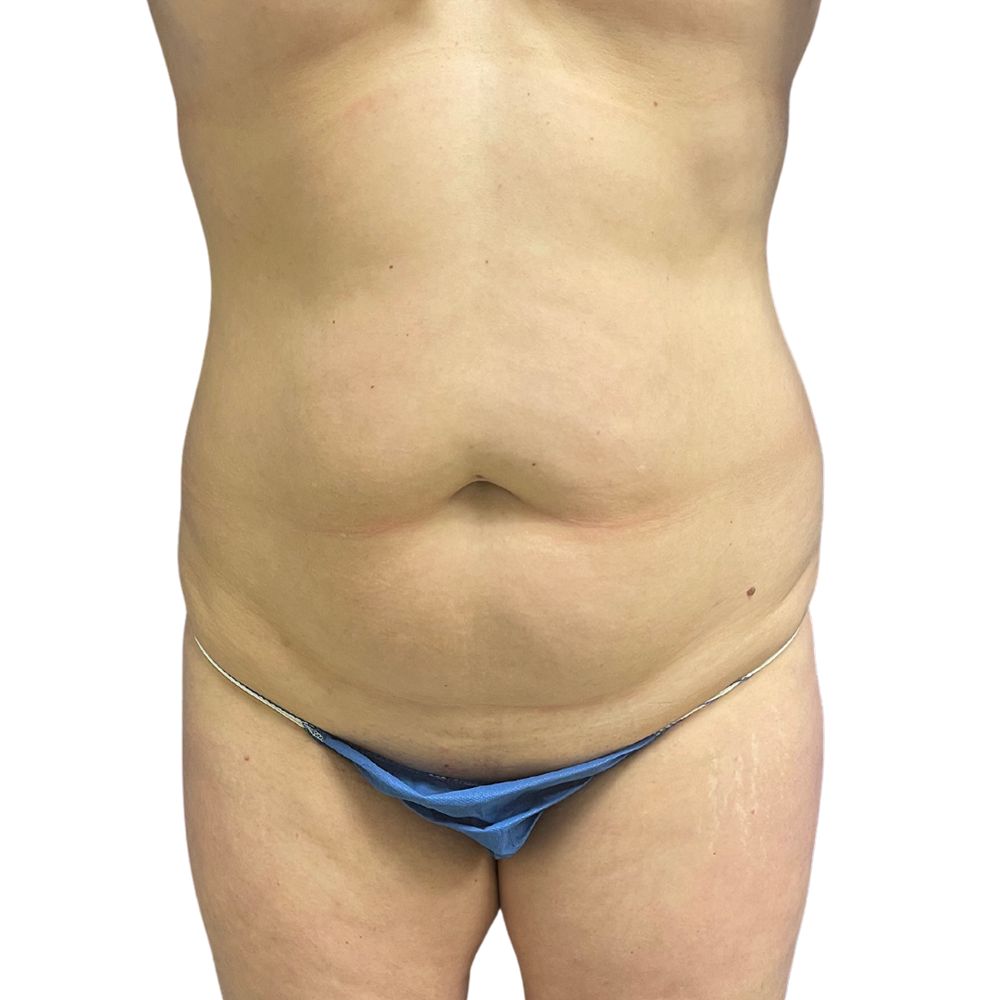 Tummy Tuck Before & After Patient #314