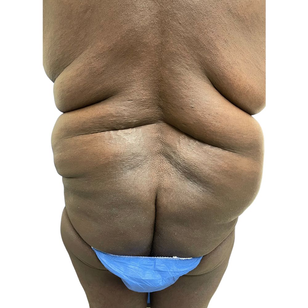 Abdominal Before & After Patient #319