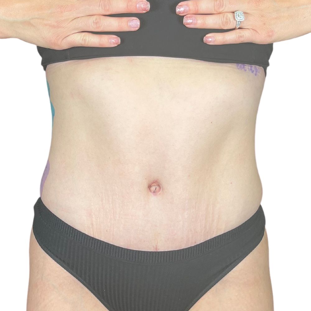 Tummy Tuck Before & After Patient #327