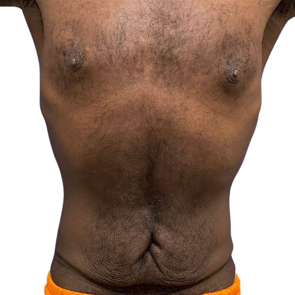 Tummy Tuck Before & After Patient #330