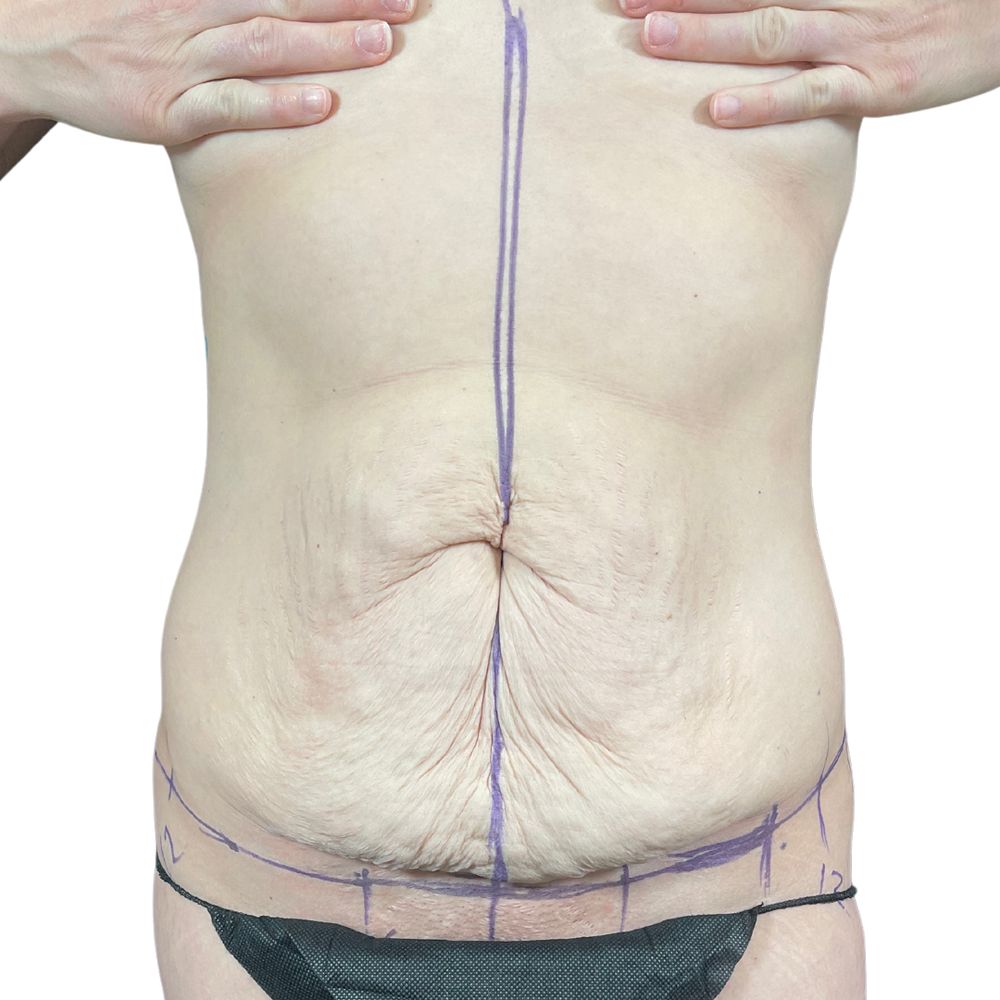 Tummy Tuck Before & After Patient #327