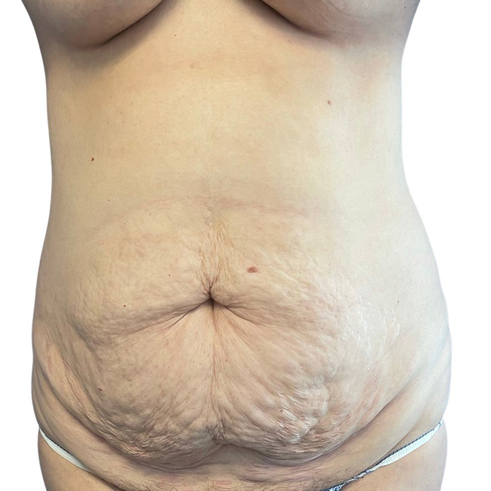 Tummy Tuck Before & After Patient #333