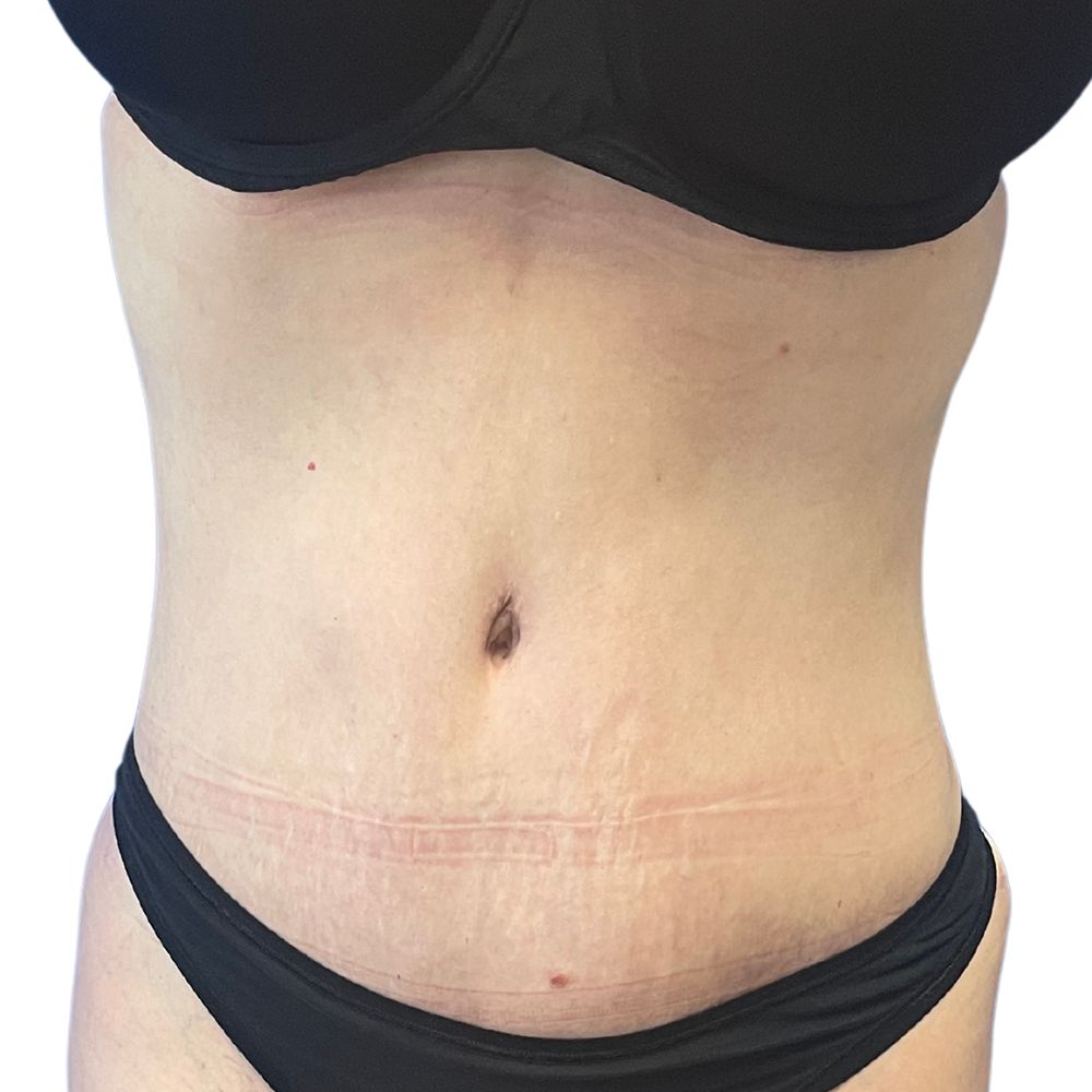 Tummy Tuck Before & After Patient #333