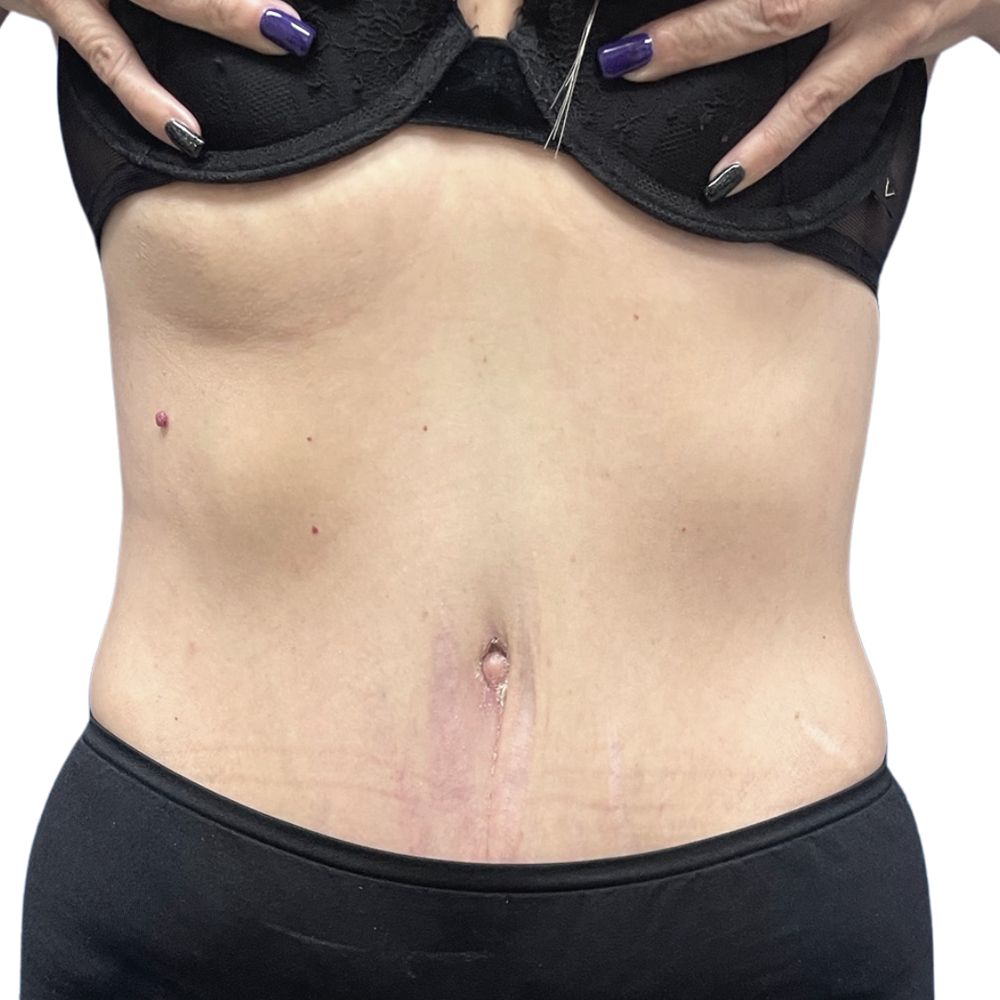 Tummy Tuck Before & After Patient #336
