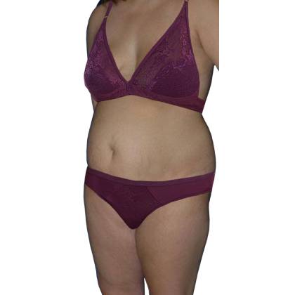 Tummy Tuck Before & After Patient #511