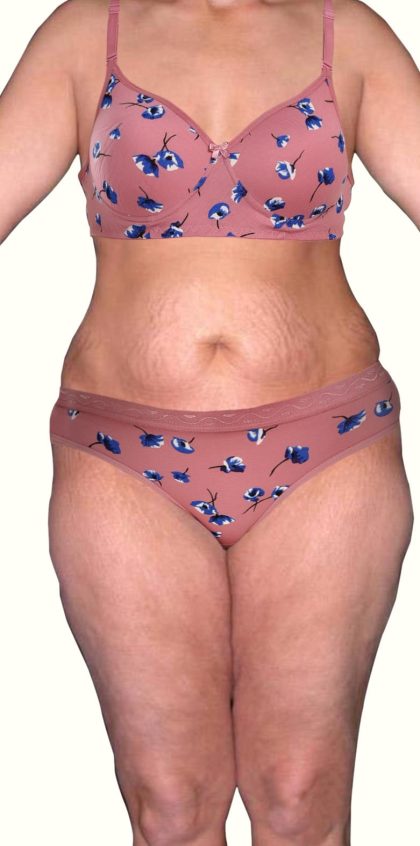 Tummy Tuck Before & After Patient #541
