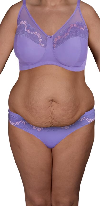 Liposuction Before & After Patient #518