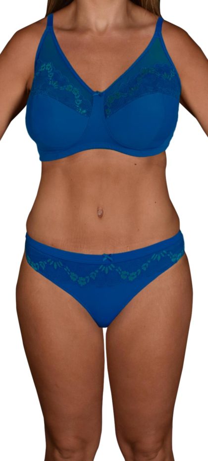 Liposuction Before & After Patient #518