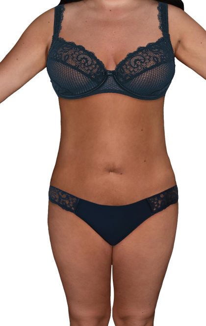 Liposuction Before & After Patient #532