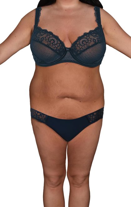 Liposuction Before & After Patient #532