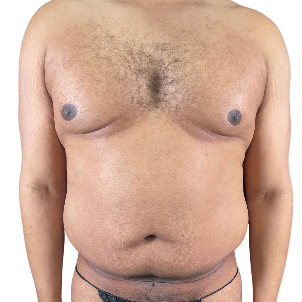 Abdominal-Liposuction-1-1a