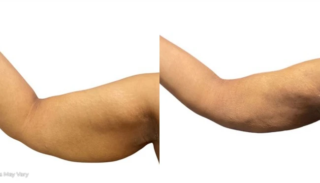 Best High Definition Arms Beverly Hills Tarzana CA Body By Batal