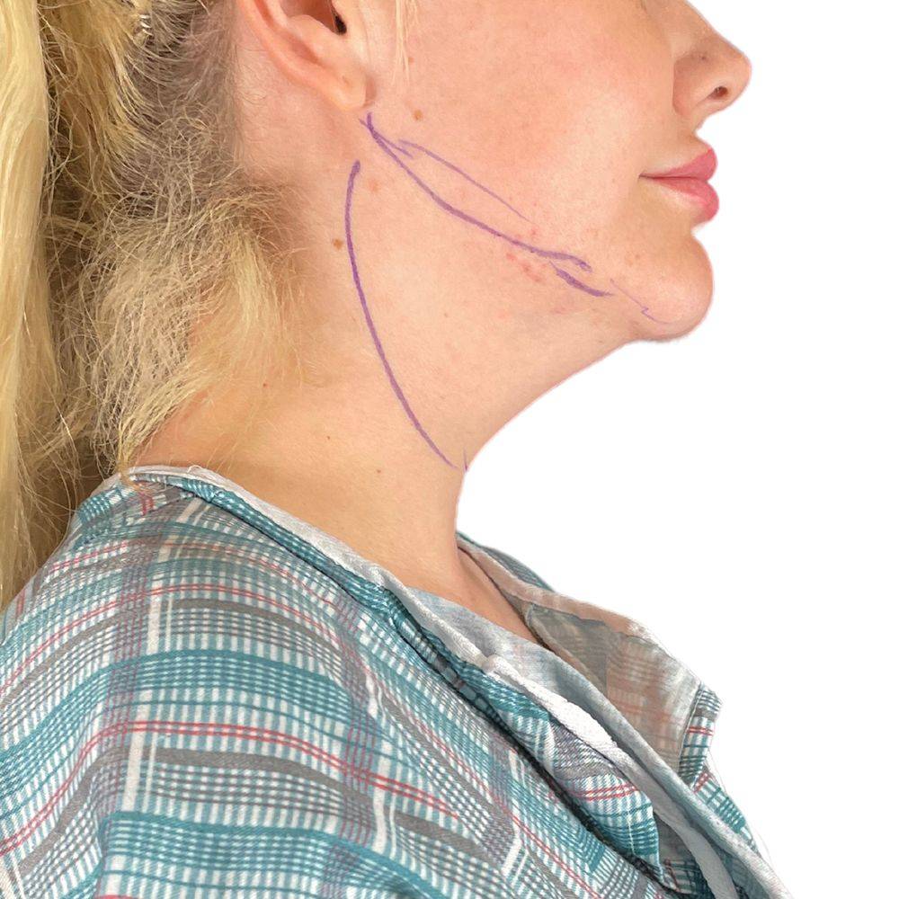 Facelift in Los Angeles, CA by Dr. Batal