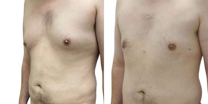Gynecomastia Before & After Patient #227