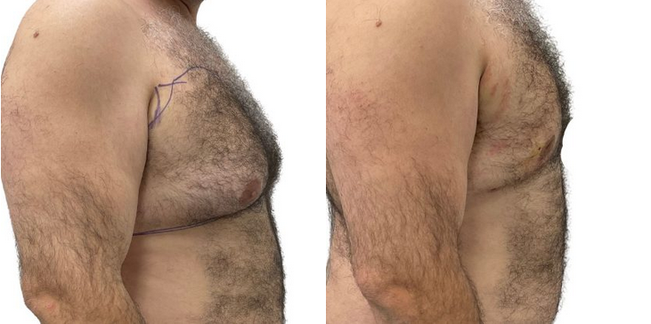 Gynecomastia Before & After Patient #223