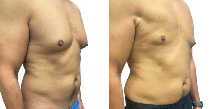 Gynecomastia Before & After Patient #206