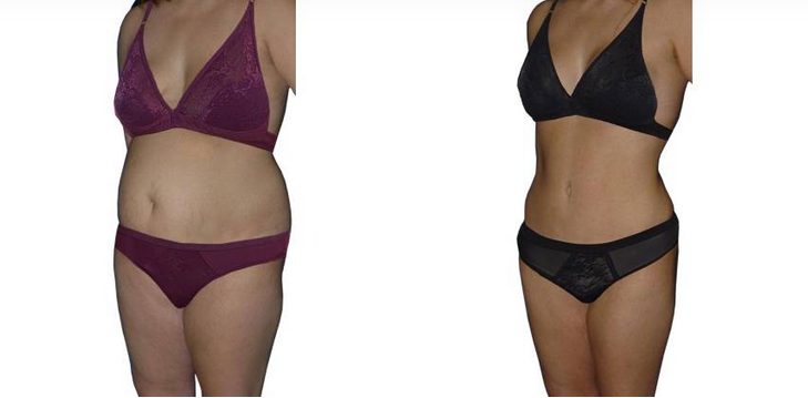 Best Liposuction Beverly Hills Tarzana CA Body By Batal