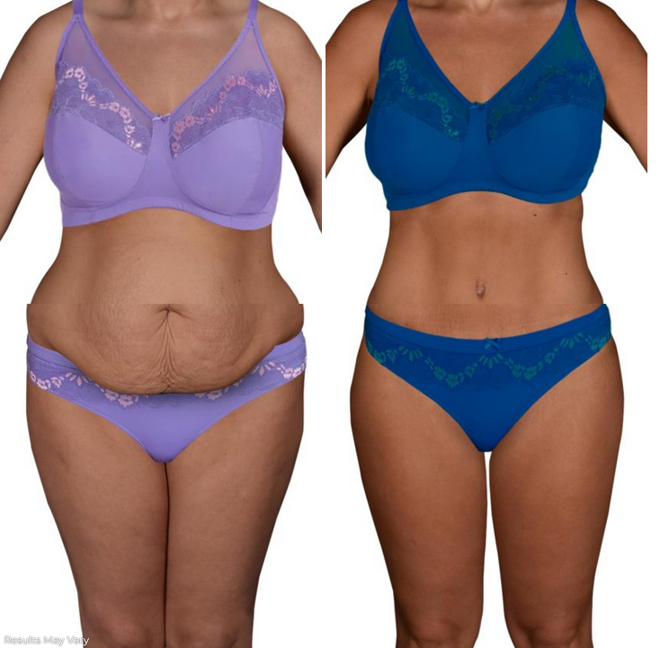 Liposuction of the Stomach - cost, prices and specials in Ventura County,  California