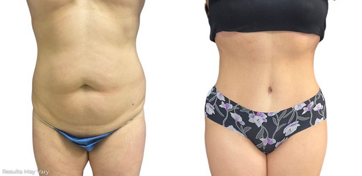 Liposuction - Abdominal Etching & Sculpting Before and After Photo Gallery, Los Angeles, CA