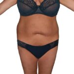 tummy-tuck-713-view-1-detail-копия-6-копия-420x665