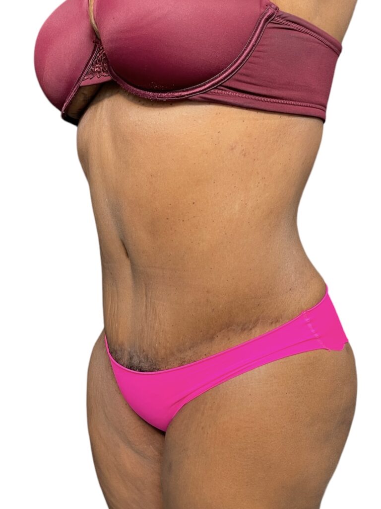 Feel Your Best this Swimsuit Season with a Tummy Tuck - Nicholas