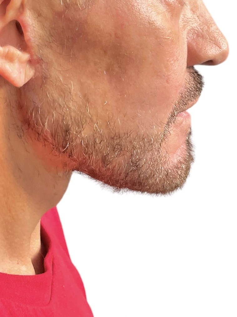 Chin Lipo LA, CA By Dr. Batal