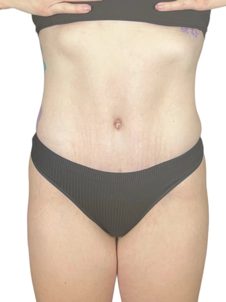 Tummy tuck after 4 months