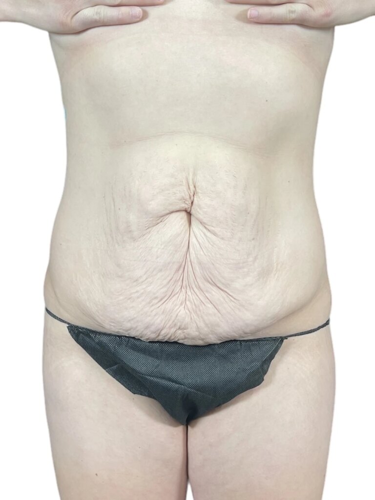 Tummy tuck before