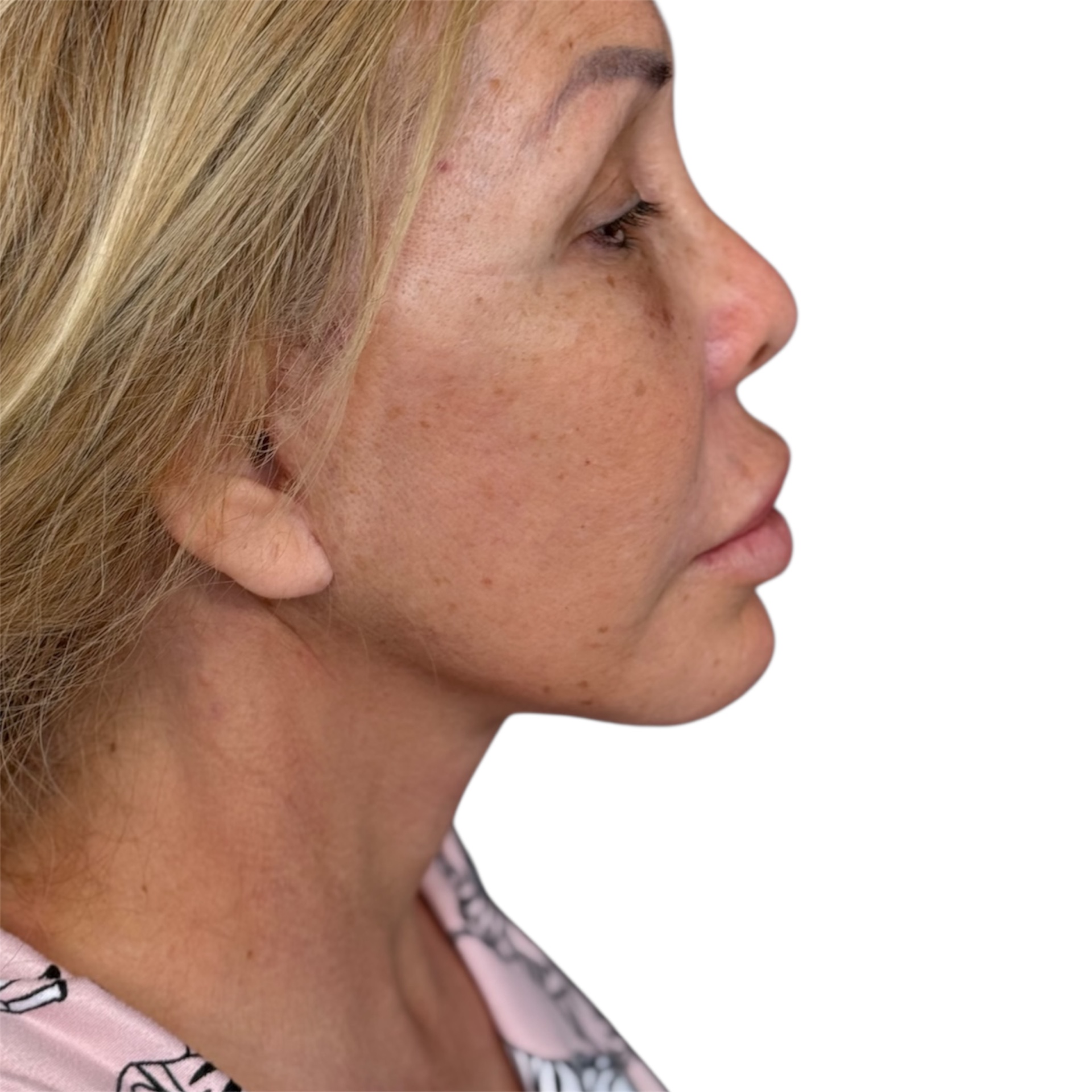 neck lift after