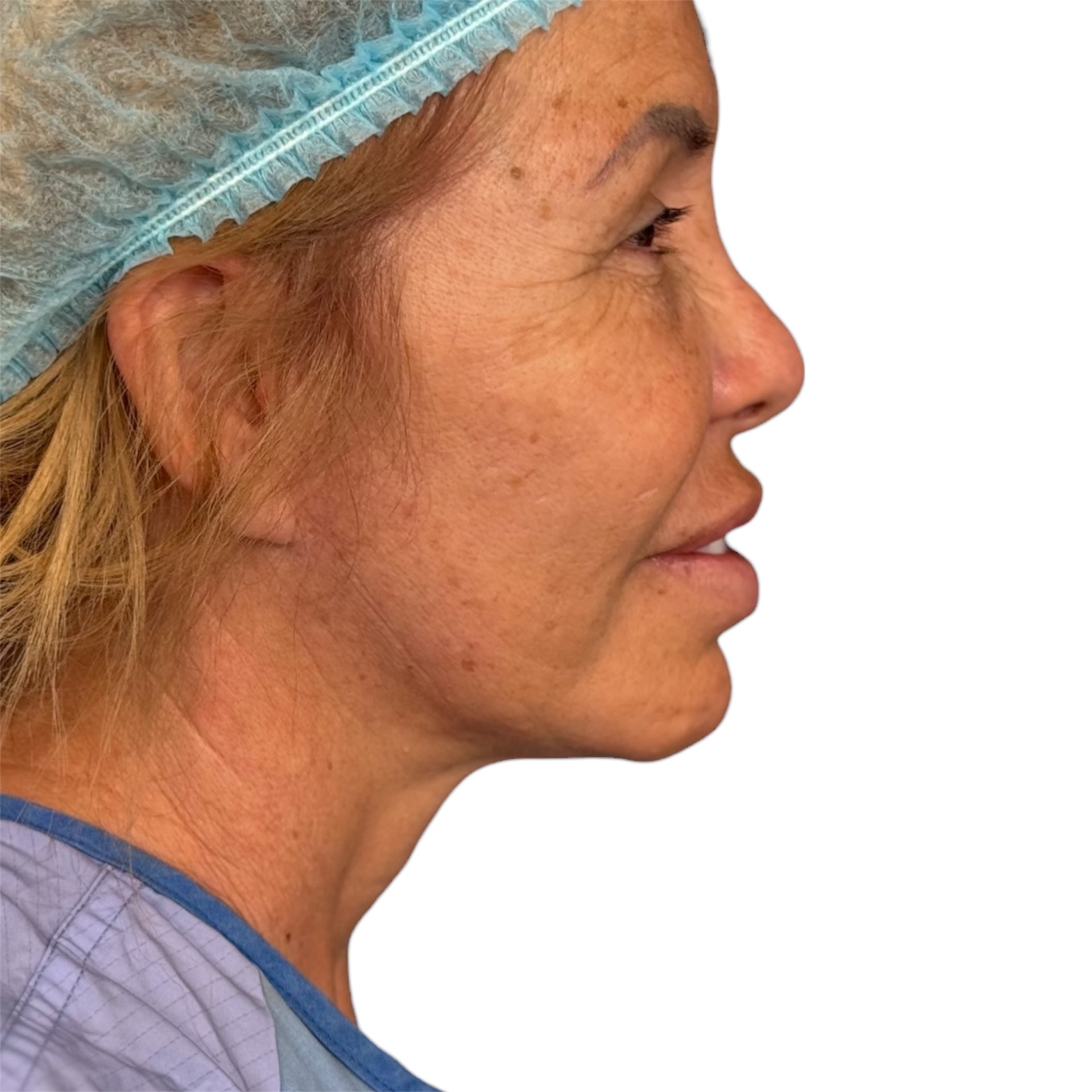neck lift before