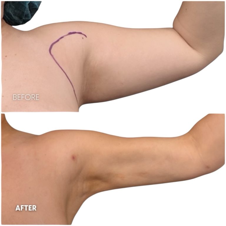 360 lipo arms result 2