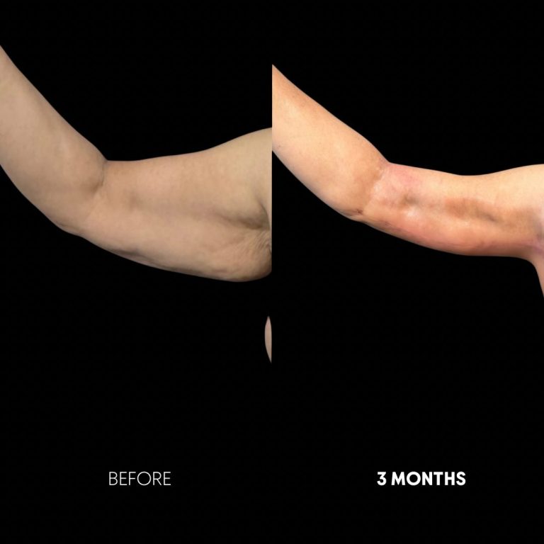 360 lipo arms result 3