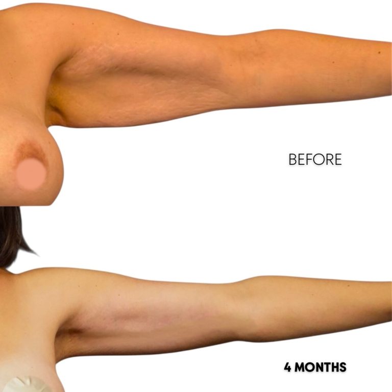 360 lipo arms result