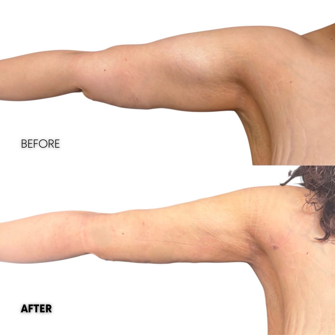 High def arm lipo 360 results