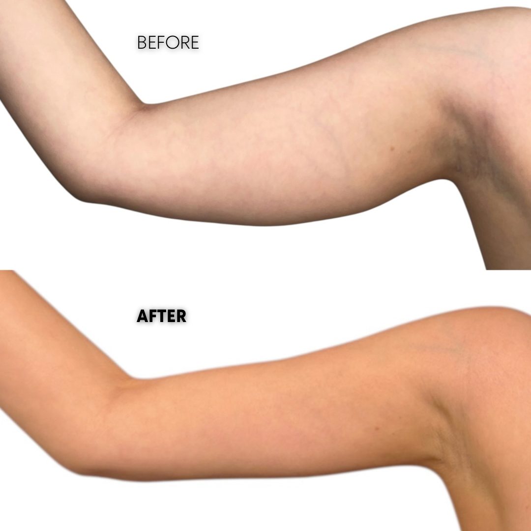 High definition arms lipo 360
