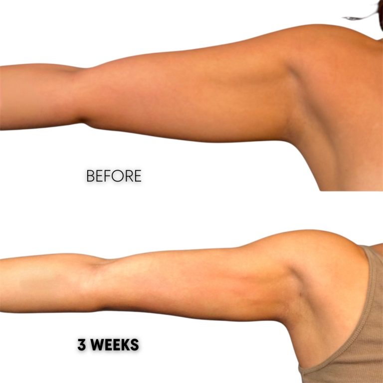 arm lipo 360 before after HD