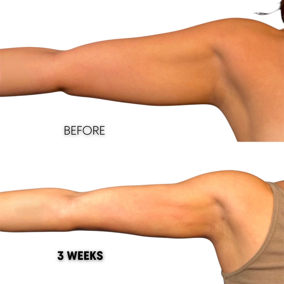 arm lipo 360 before after HD