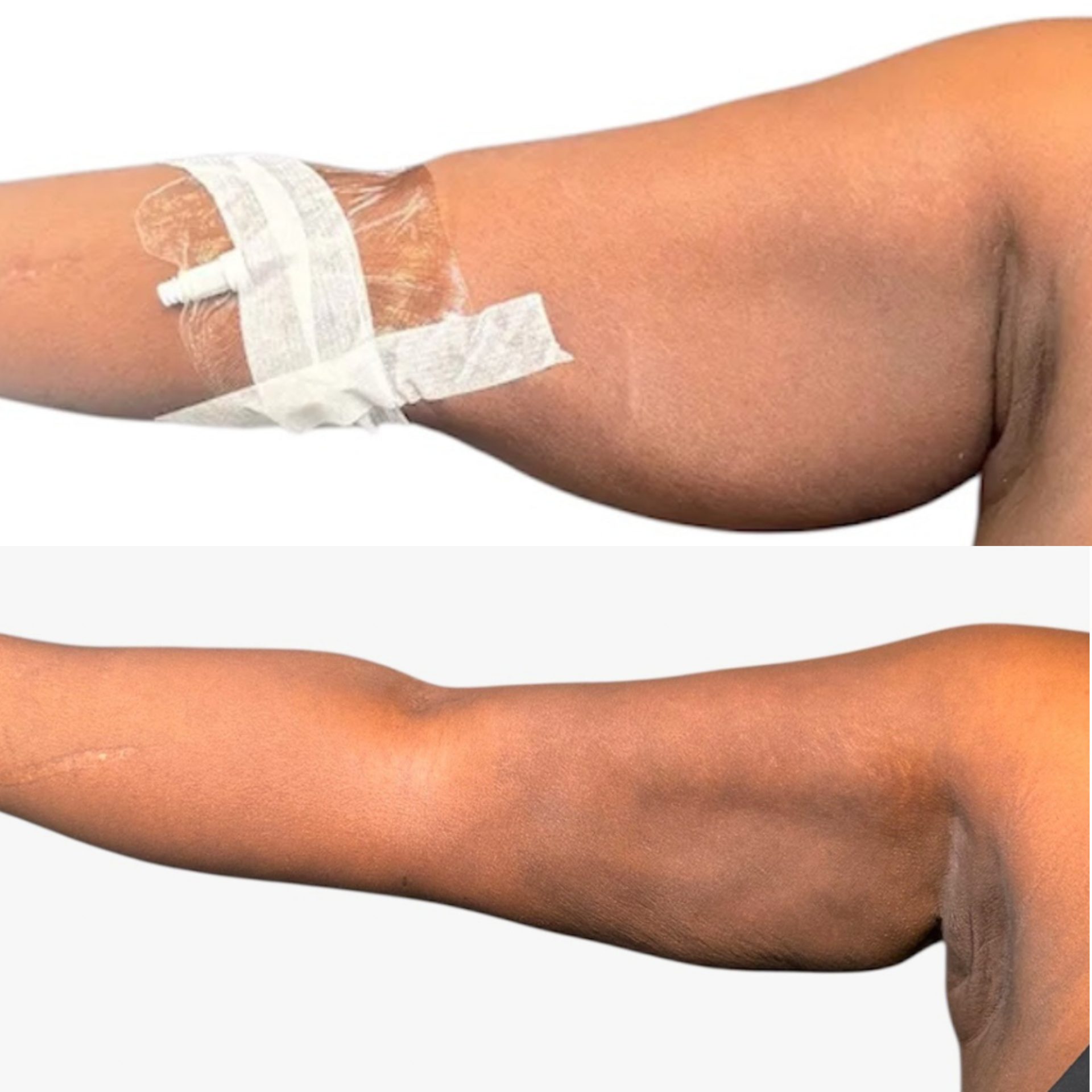 arm lipo 360 before after High def