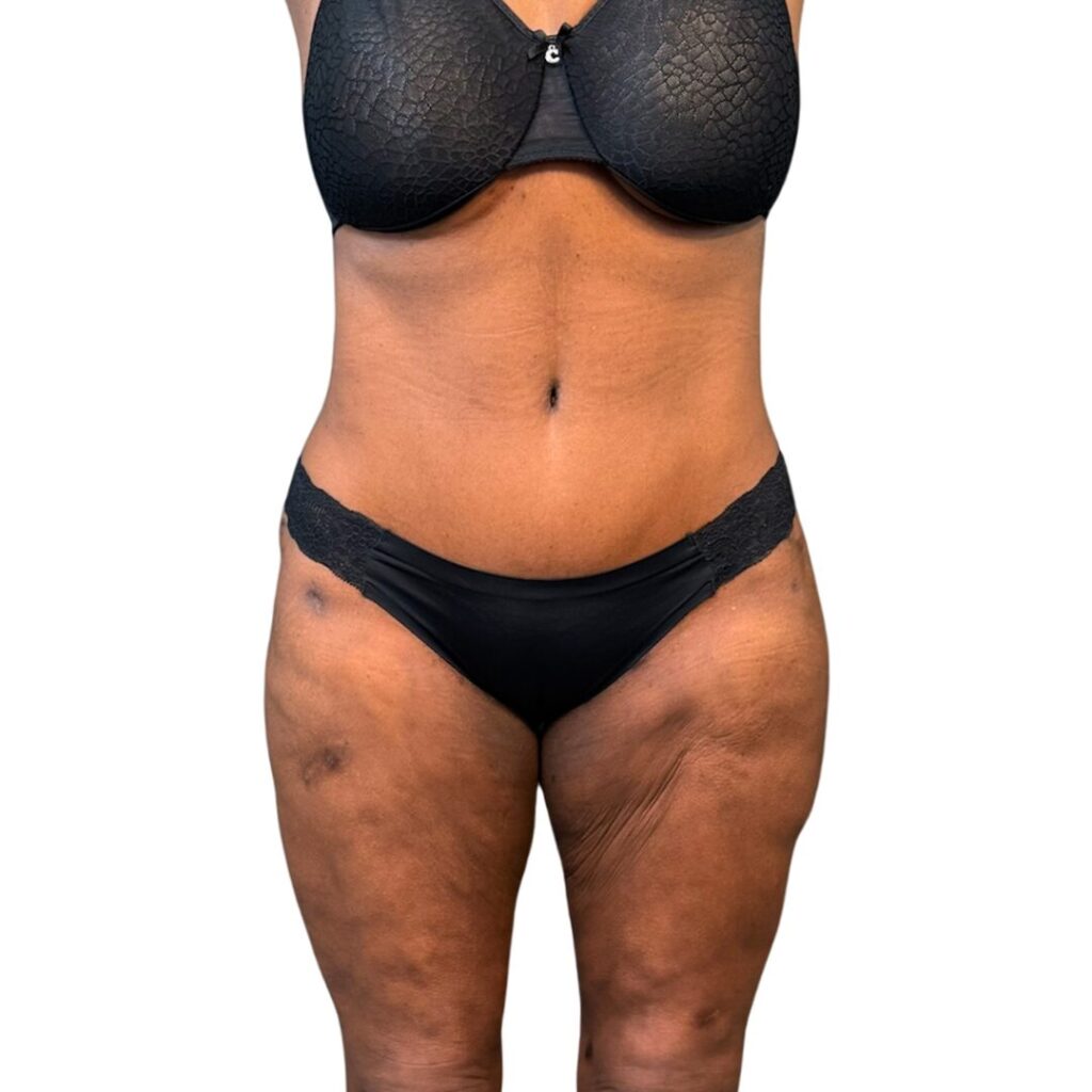 lipo 360 tummy tuck after 1