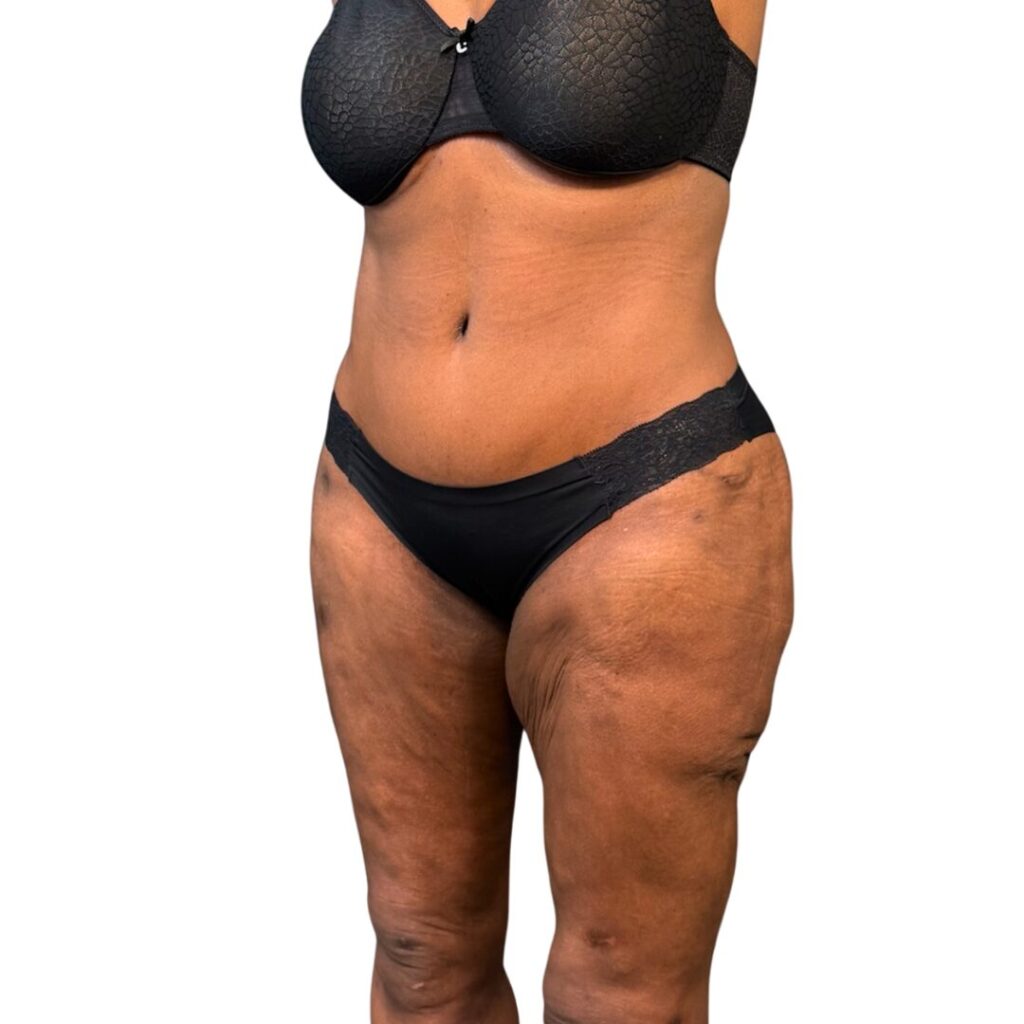 lipo 360 tummy tuck after 2