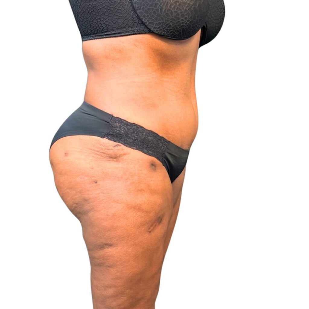 lipo 360 tummy tuck after 3