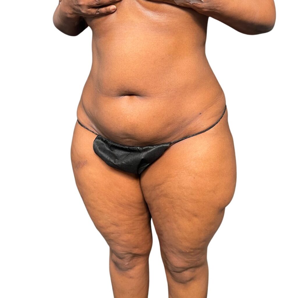 lipo 360 tummy tuck before