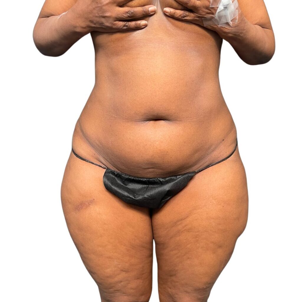 lipo 360 tummy tuck before 2