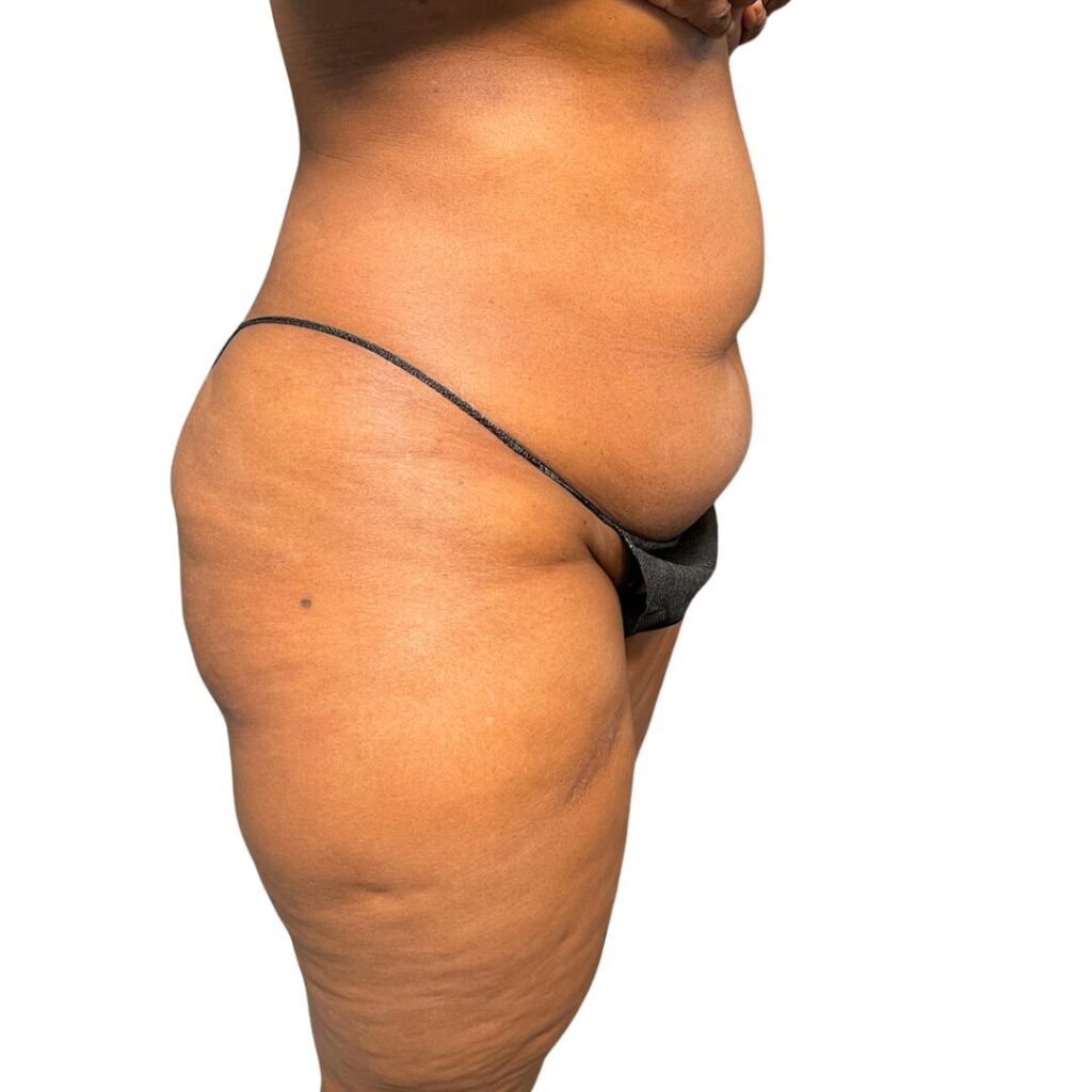 lipo 360 tummy tuck before 3
