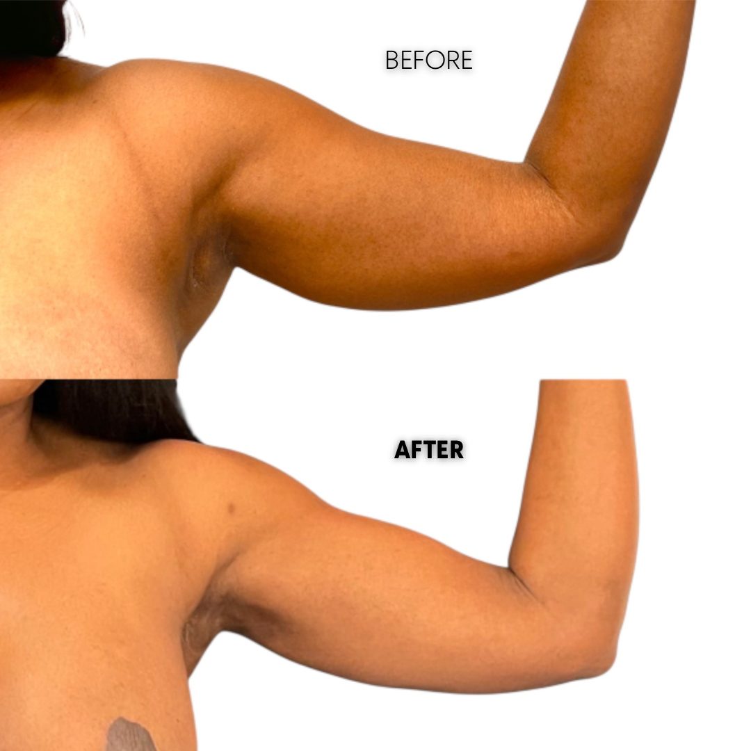 super high def arm lipo 360 results